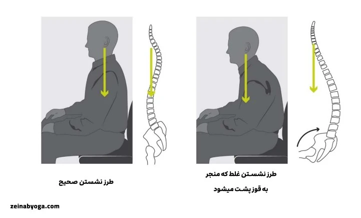 پیشگیری از ابتلا به قوز پشت